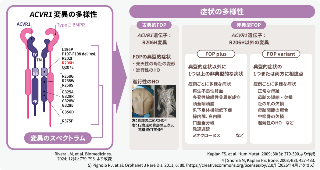 ACVR1変異の多様性とFOP症状の多様性の解説図。R206H変異の古典型FOPでは母趾変形や進行性HO等の典型的症状を呈し、それ以外の変異による非典型FOP（プラス、バリアント）では症例ごとに多様な病状を呈することが示されています。